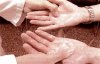 Cirug�a de Hiperhidrosis