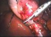 Cirug�a de Ves�cula (C�lculos)